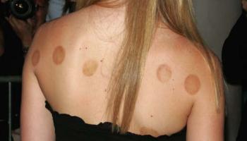 Gwyneth Paltrow with the marks caused by "cupping"